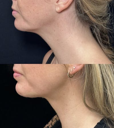 Necklift Before & After Gallery - Patient 155780 - Image 6