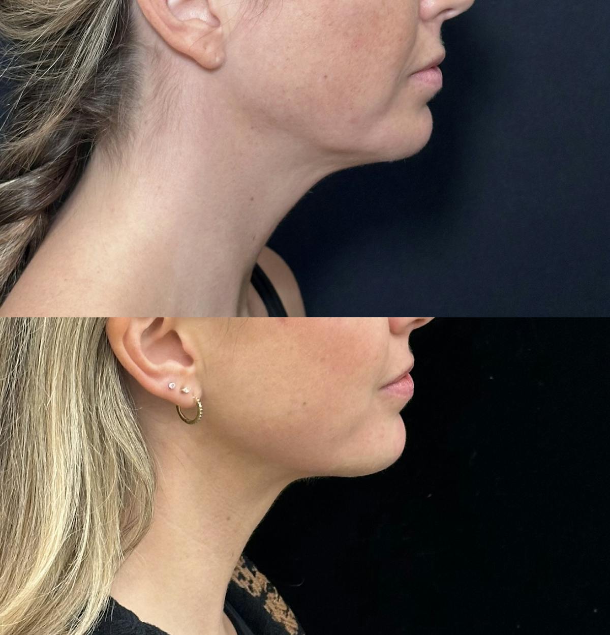 Necklift Before & After Gallery - Patient 155780 - Image 1