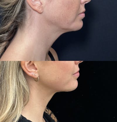 Necklift Before & After Gallery - Patient 155780 - Image 1