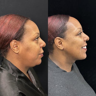Chin & Neck Lipo Sculpting Before & After Gallery - Patient 284999 - Image 4
