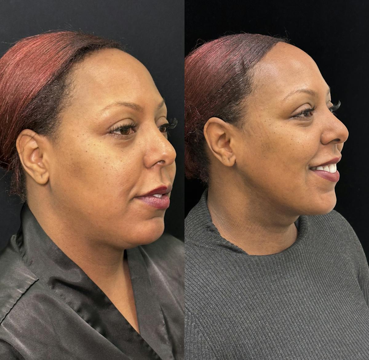 Chin & Neck Lipo Sculpting Before & After Gallery - Patient 284999 - Image 3