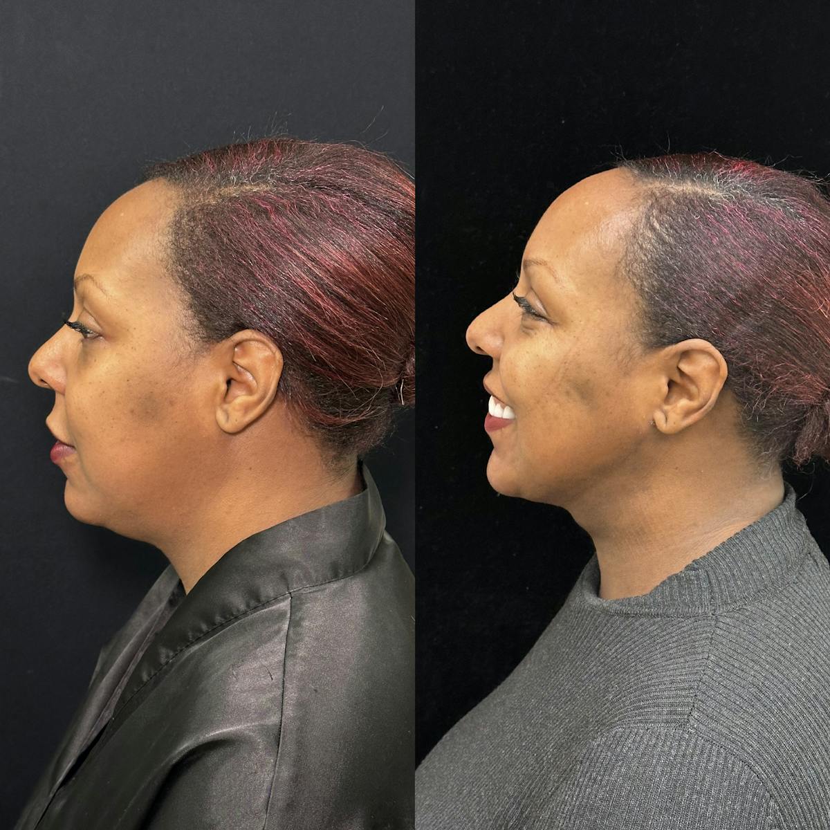 Chin & Neck Lipo Sculpting Before & After Gallery - Patient 284999 - Image 1