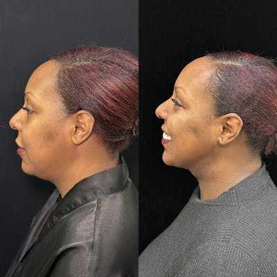Chin & Neck Lipo Sculpting Before & After Gallery - Patient 284999 - Image 1