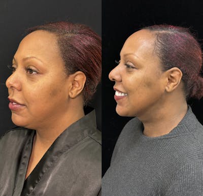 Chin & Neck Lipo Sculpting Before & After Gallery - Patient 284999 - Image 2