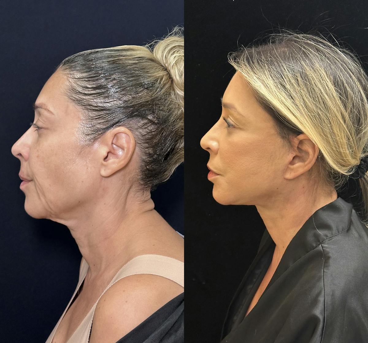 Necklift Before & After Gallery - Patient 679331 - Image 3