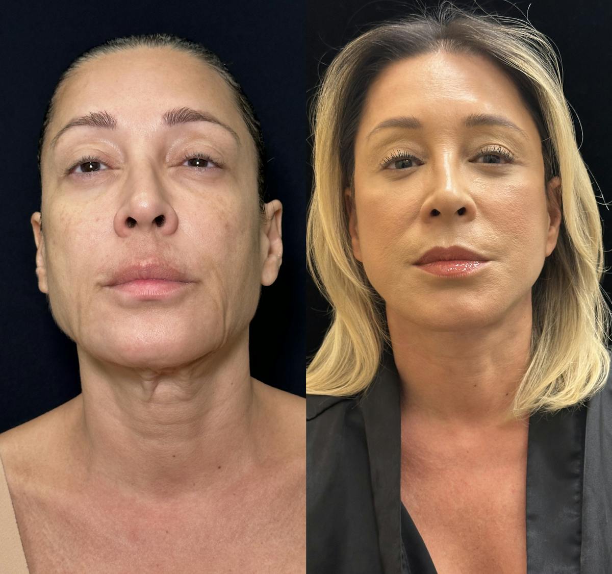 Necklift Before & After Gallery - Patient 679331 - Image 1