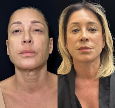 Deep Plane Facelift Before & After Gallery - Patient 351884 - Image 1