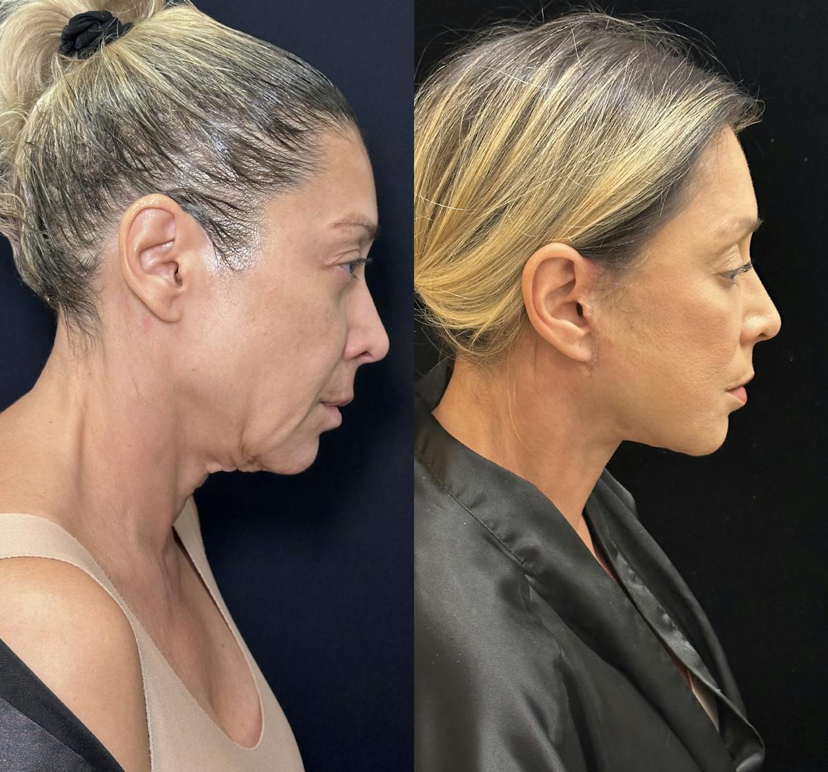 Necklift Before & After Gallery - Patient 679331 - Image 6
