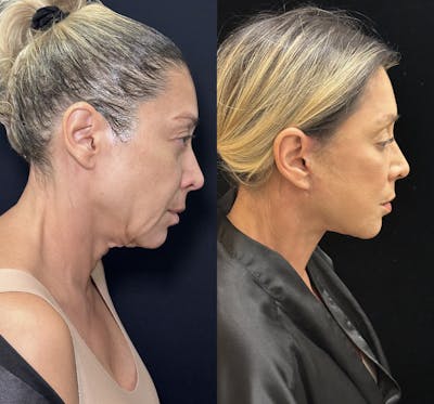 Deep Plane Facelift Before & After Gallery - Patient 351884 - Image 6