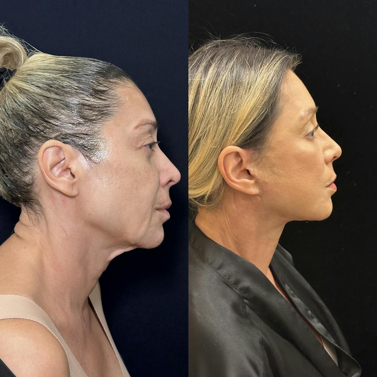Necklift Before & After Gallery - Patient 679331 - Image 5