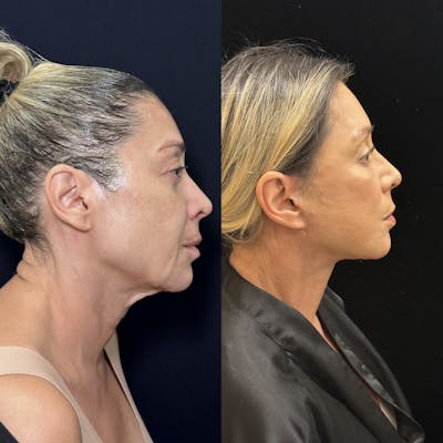 Deep Plane Facelift Before & After Gallery - Patient 351884 - Image 5