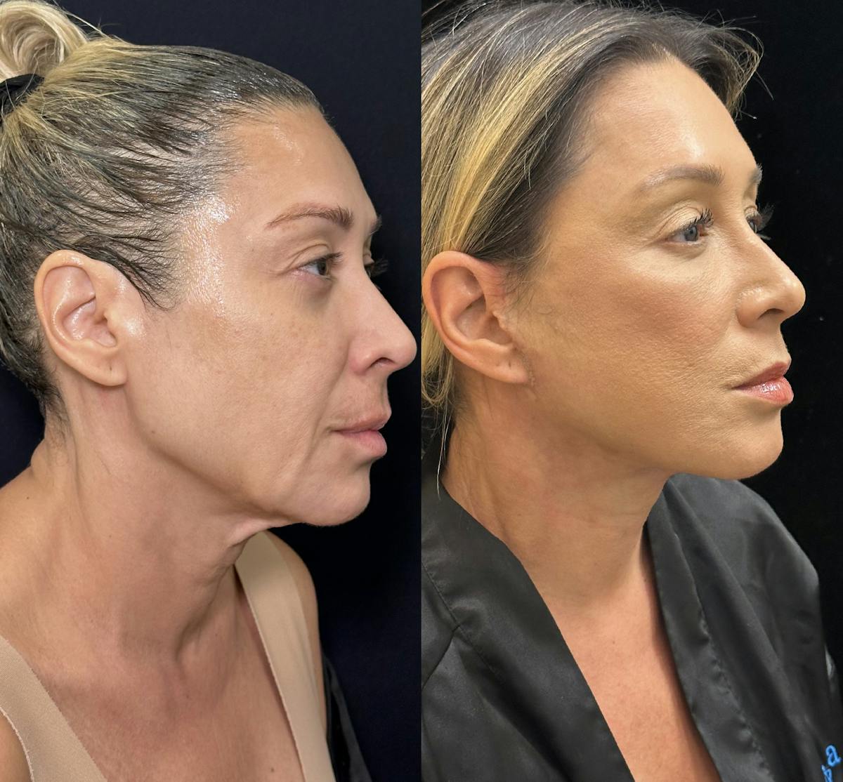 Necklift Before & After Gallery - Patient 679331 - Image 7