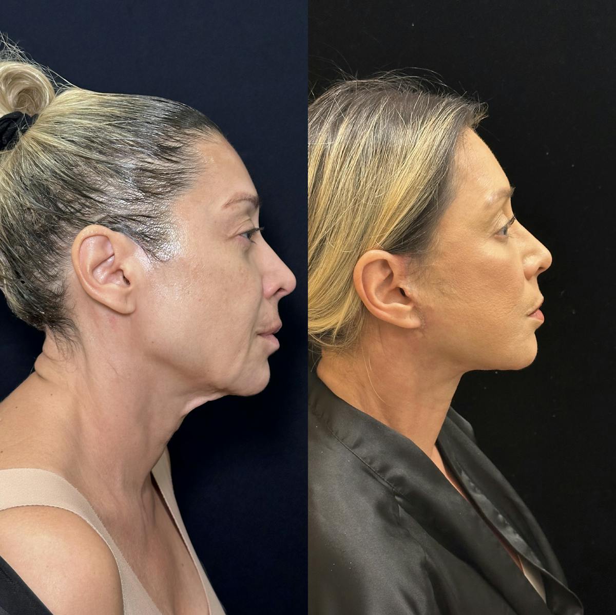 Necklift Before & After Gallery - Patient 679331 - Image 4