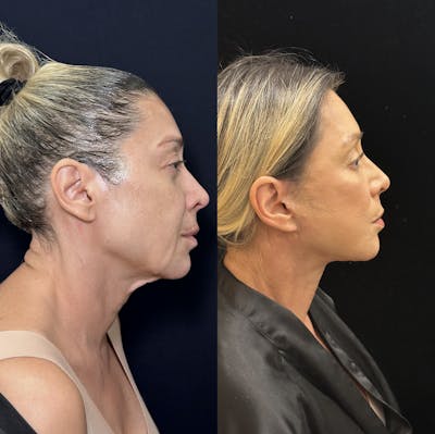 Deep Plane Facelift Before & After Gallery - Patient 351884 - Image 4