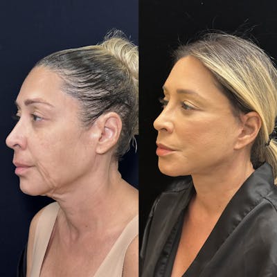 Deep Plane Facelift Before & After Gallery - Patient 351884 - Image 2