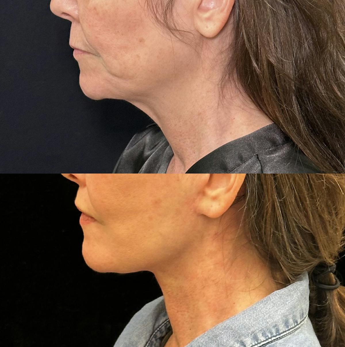 Lip Lift Before & After Gallery - Patient 346766 - Image 3