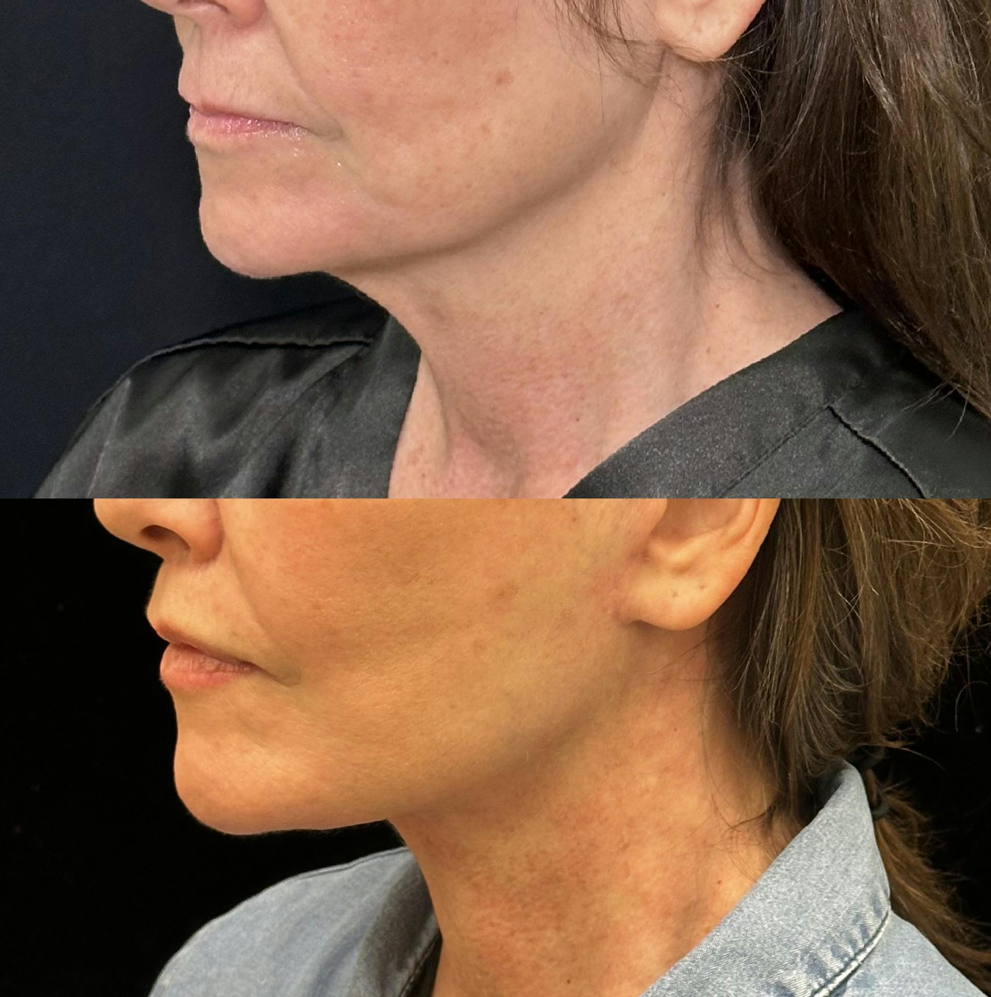 Necklift Before & After Gallery - Patient 248180 - Image 2