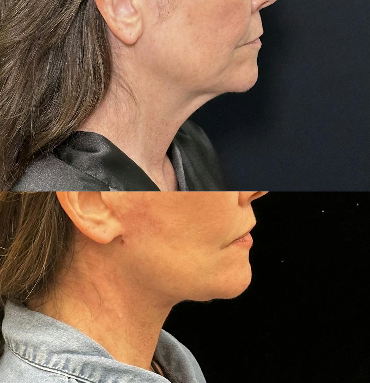 Lip Lift Before & After Gallery - Patient 346766 - Image 5