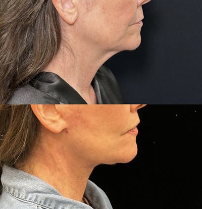 Deep Plane Facelift Before & After Gallery - Patient 166280 - Image 5