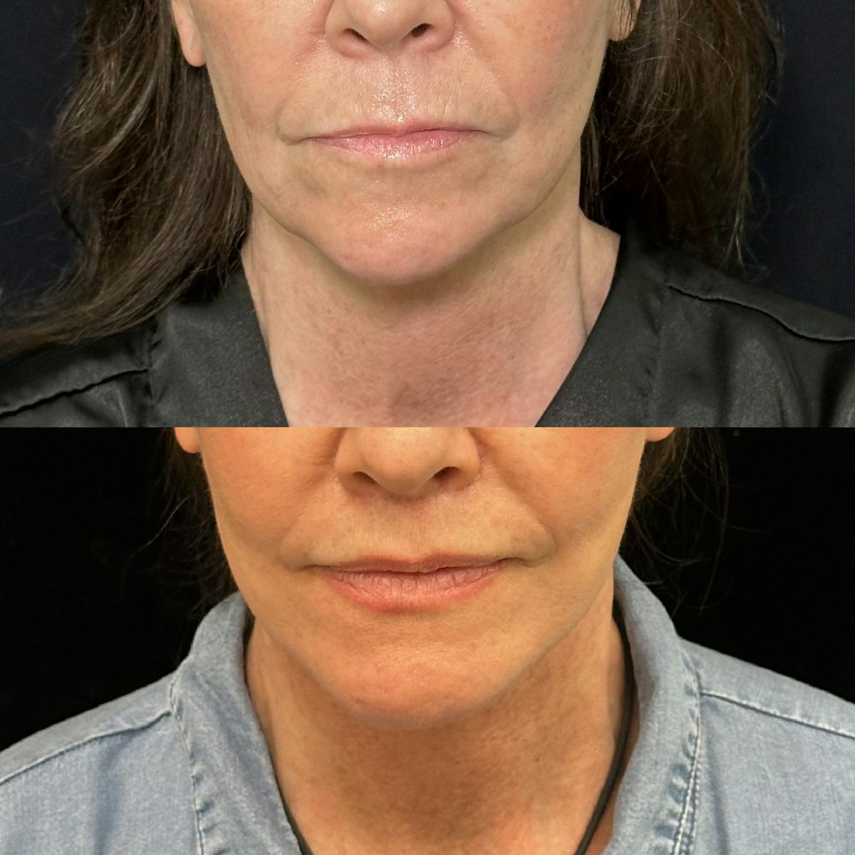 Lip Lift Before & After Gallery - Patient 346766 - Image 1