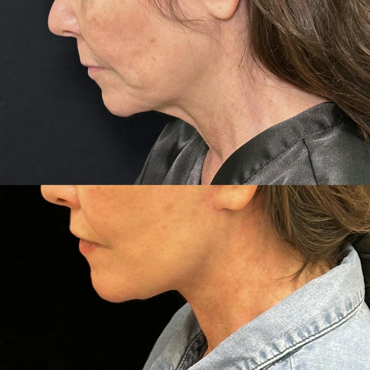 Lip Lift Before & After Gallery - Patient 346766 - Image 4