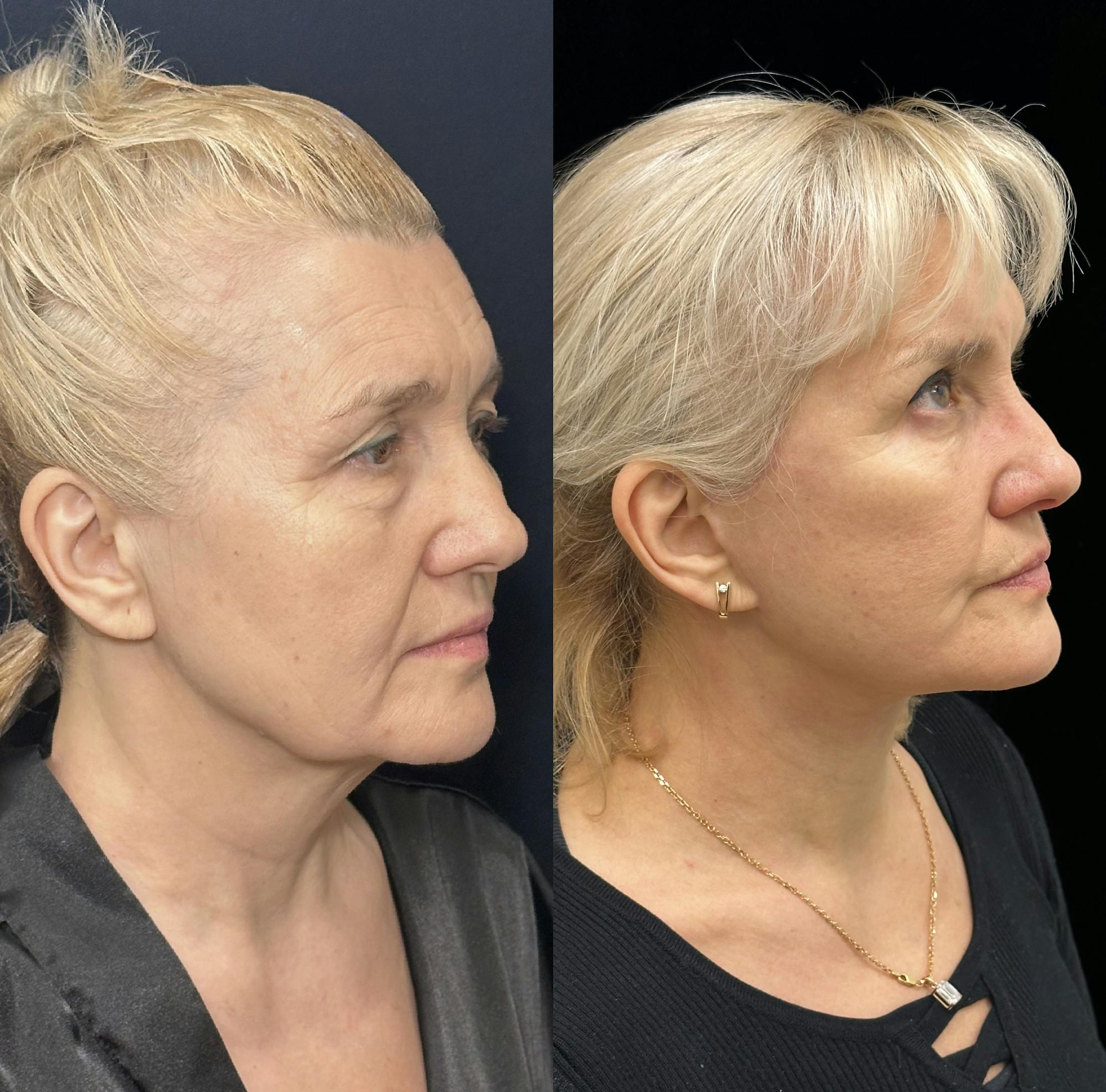 Deep Plane Facelift Before & After Gallery - Patient 325583 - Image 3