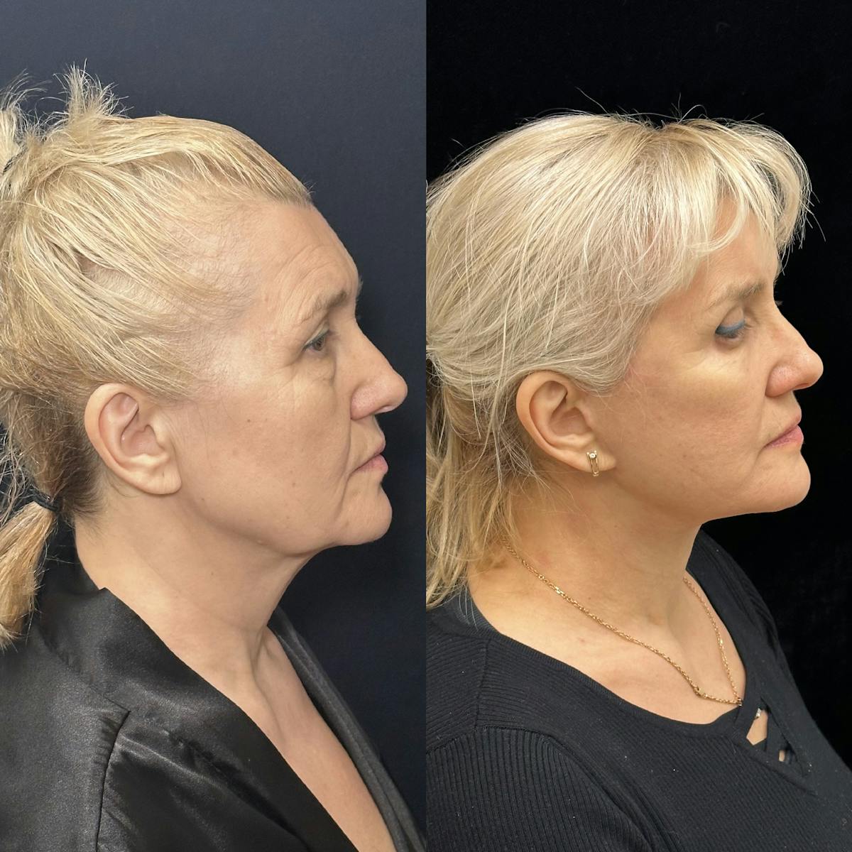 Lower Blepharoplasty Before & After Gallery - Patient 254135 - Image 2