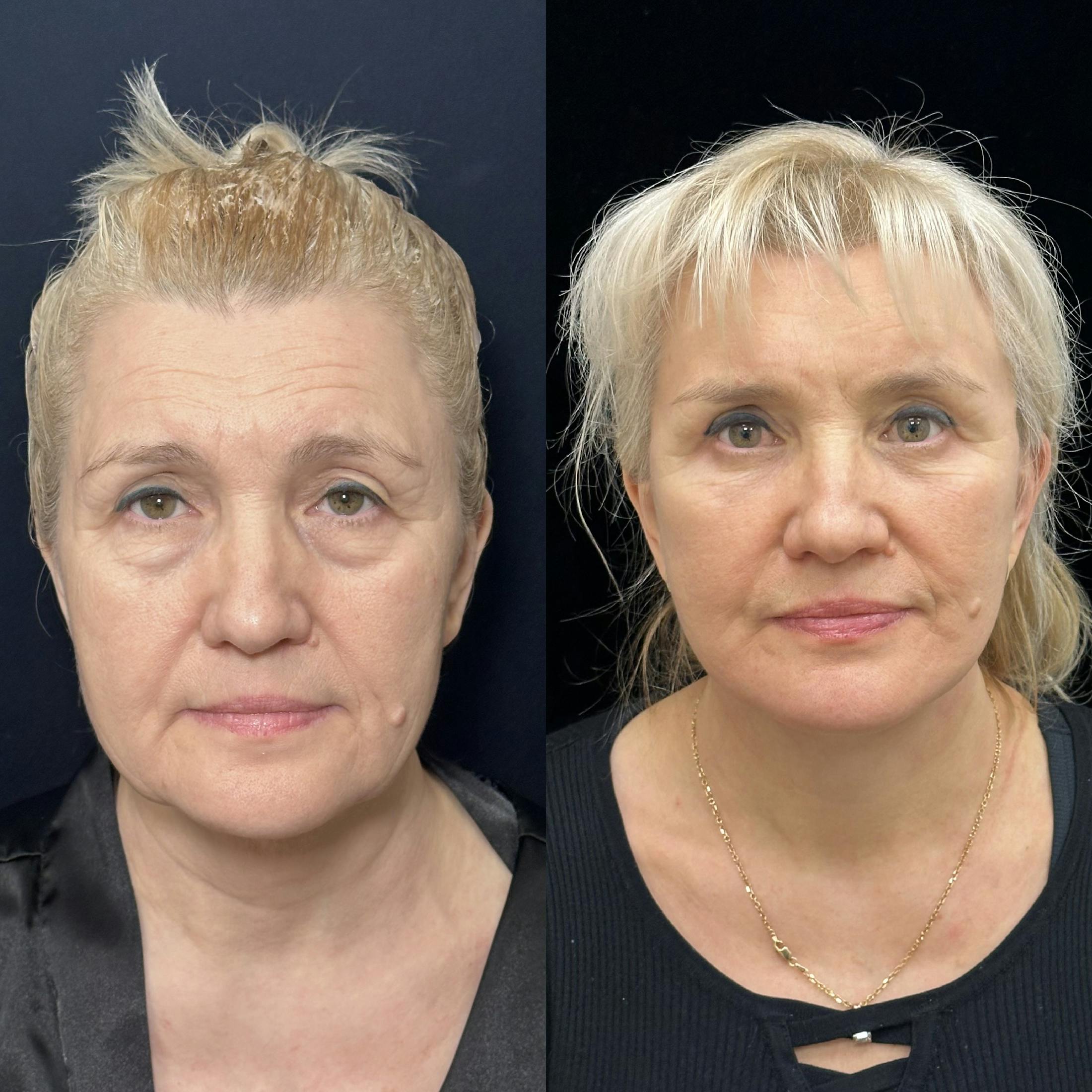 Deep Plane Facelift Before & After Gallery - Patient 325583 - Image 1