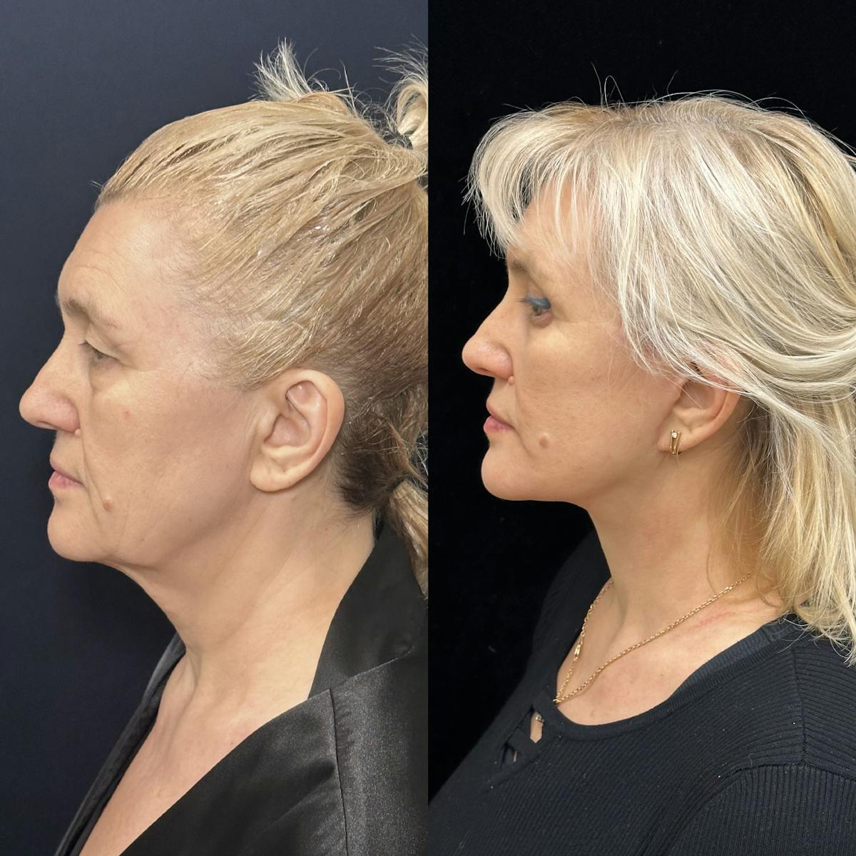 Lower Blepharoplasty Before & After Gallery - Patient 254135 - Image 5
