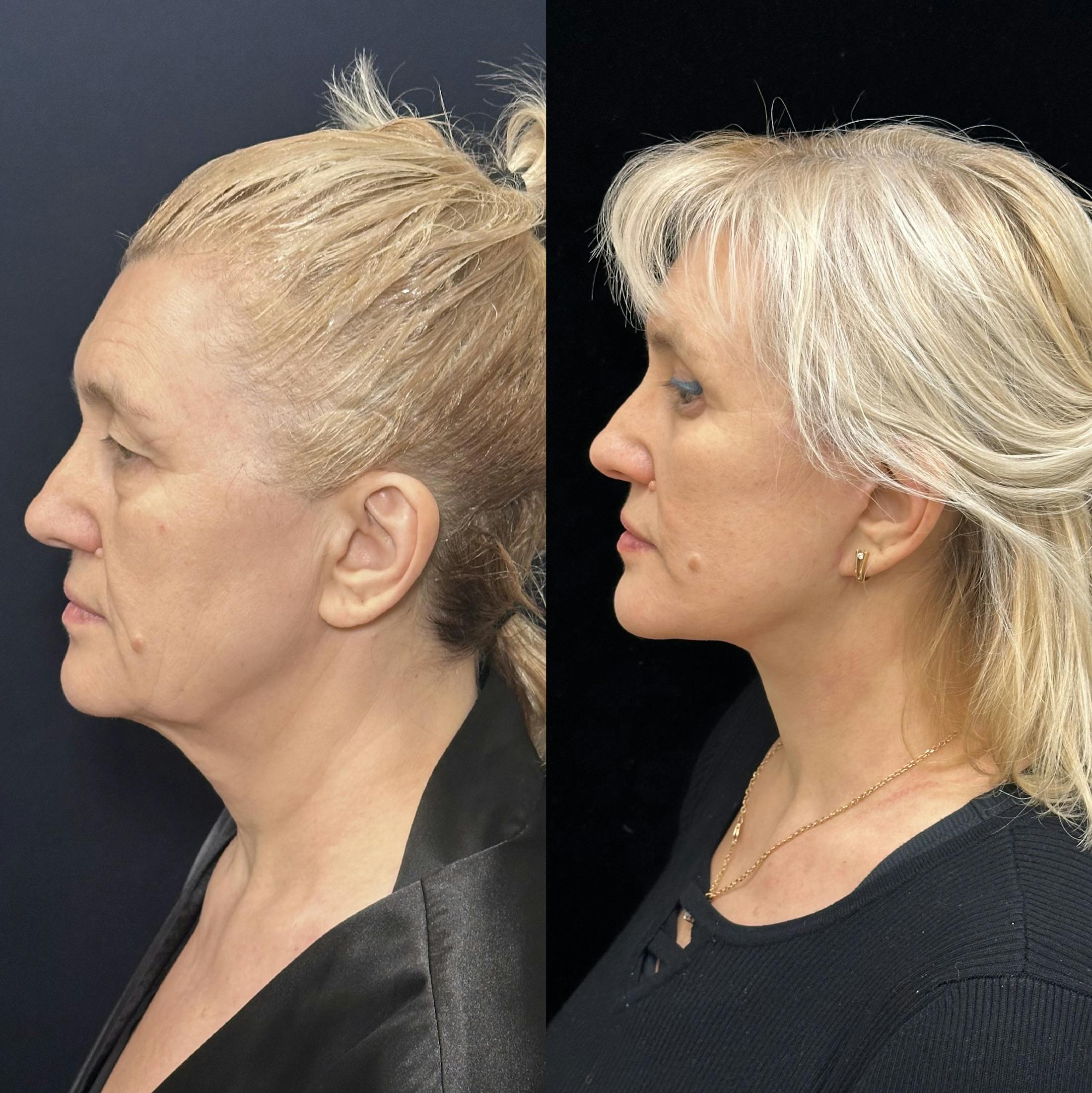 Deep Plane Facelift Before & After Gallery - Patient 325583 - Image 5
