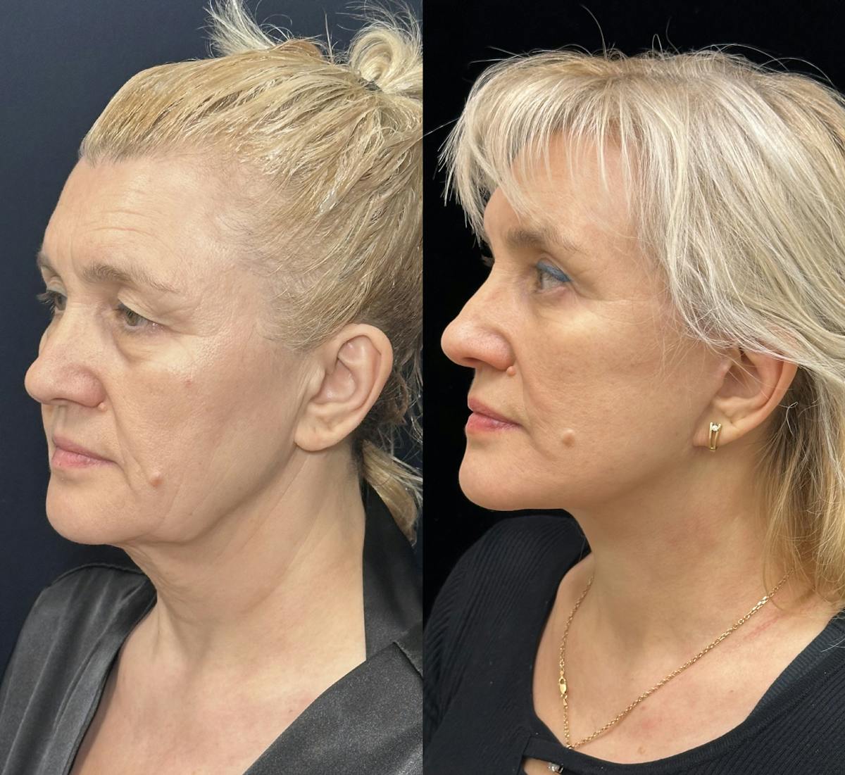 Lower Blepharoplasty Before & After Gallery - Patient 254135 - Image 4