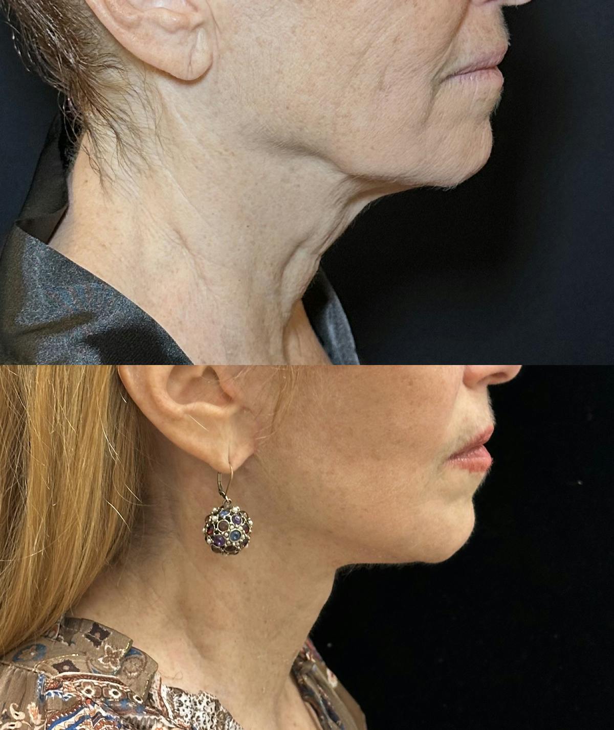 Necklift Before & After Gallery - Patient 578557 - Image 2