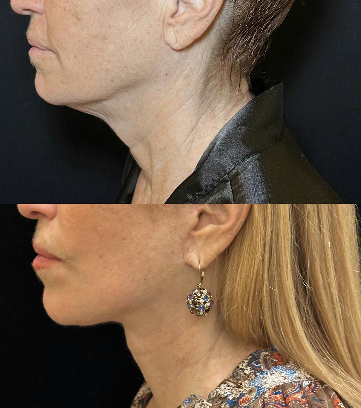 Necklift Before & After Gallery - Patient 578557 - Image 4