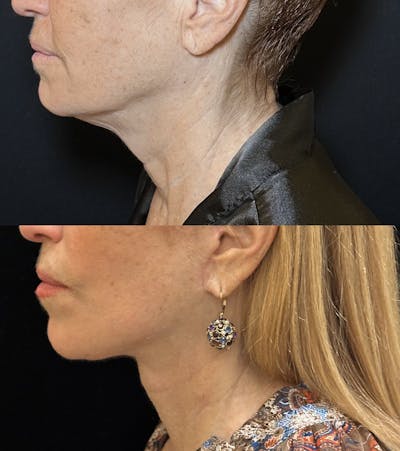 Deep Plane Facelift Before & After Gallery - Patient 126470 - Image 4