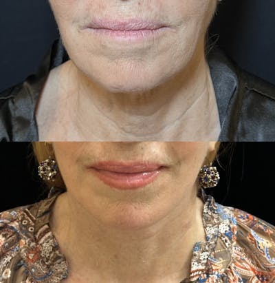 Deep Plane Facelift Before & After Gallery - Patient 126470 - Image 3
