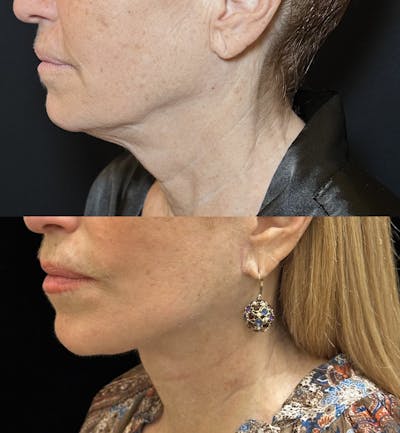 Deep Plane Facelift Before & After Gallery - Patient 126470 - Image 5