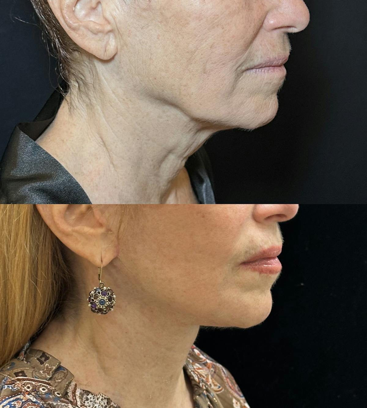 Necklift Before & After Gallery - Patient 578557 - Image 1