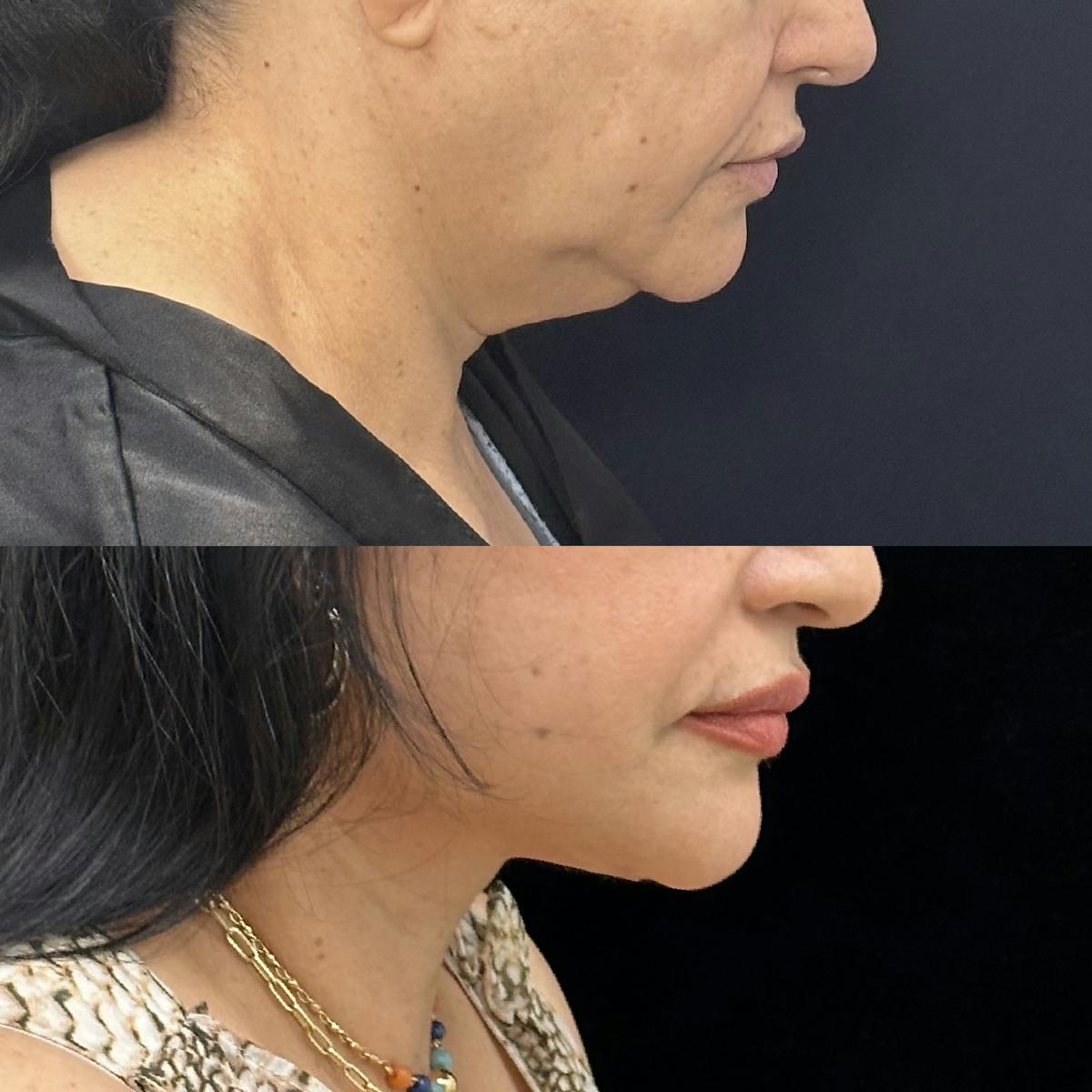 Necklift Before & After Gallery - Patient 355498 - Image 4