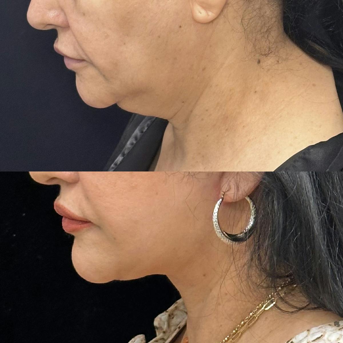 Necklift Before & After Gallery - Patient 355498 - Image 5