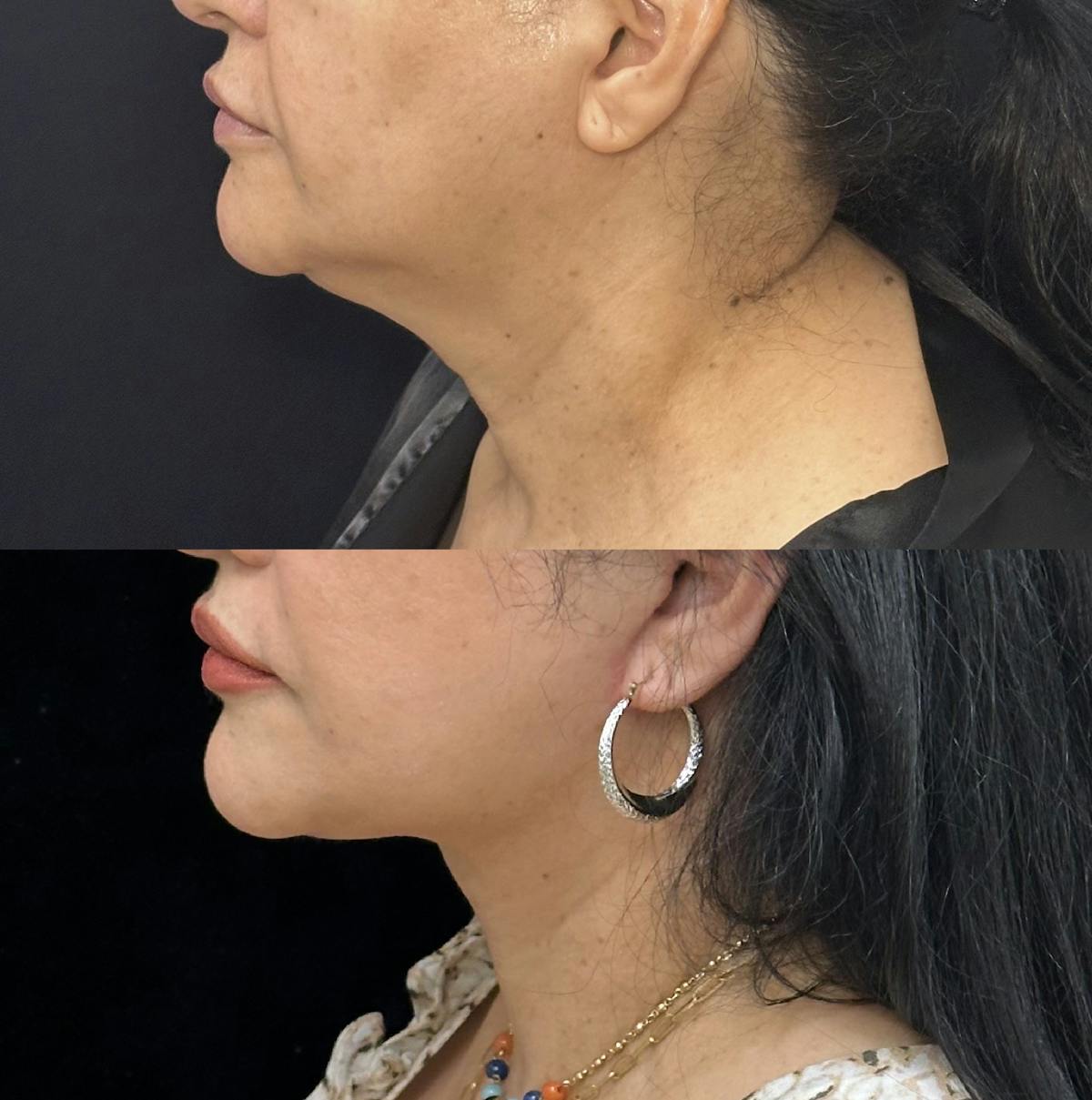 Necklift Before & After Gallery - Patient 355498 - Image 6