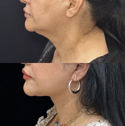 Deep Plane Facelift Before & After Gallery - Patient 410825 - Image 6