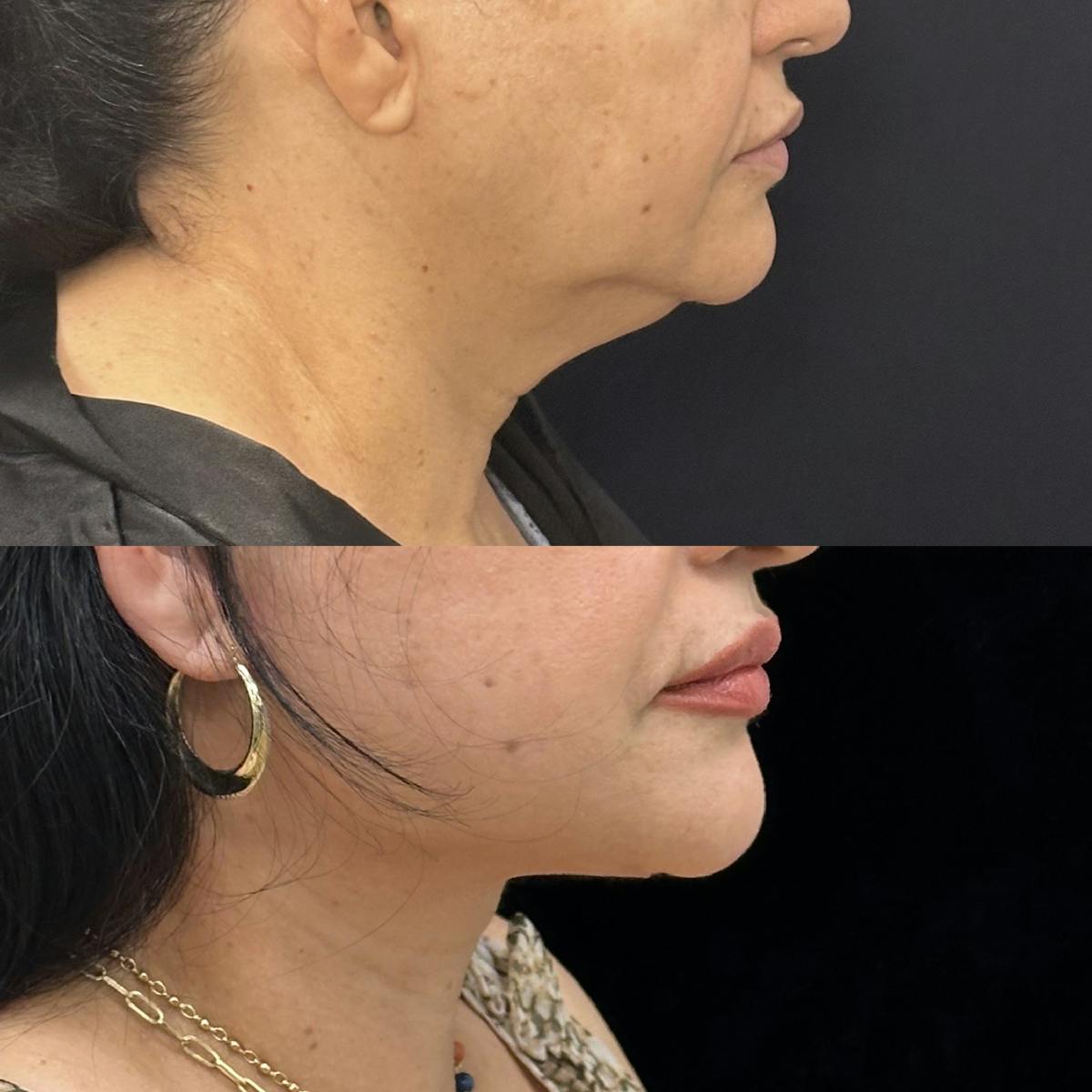 Necklift Before & After Gallery - Patient 355498 - Image 1