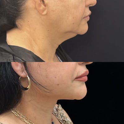 Deep Plane Facelift Before & After Gallery - Patient 410825 - Image 1