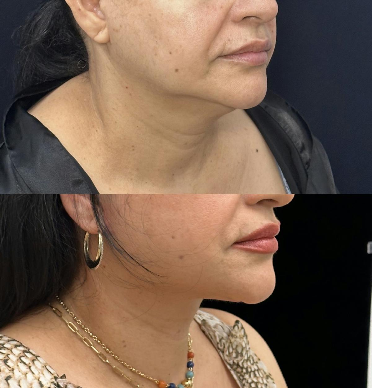 Necklift Before & After Gallery - Patient 355498 - Image 3