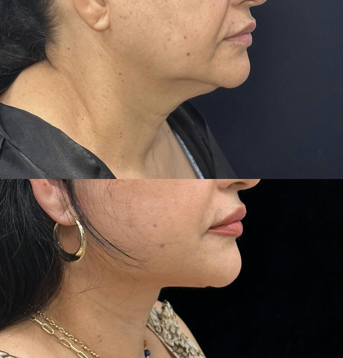 Necklift Before & After Gallery - Patient 355498 - Image 2
