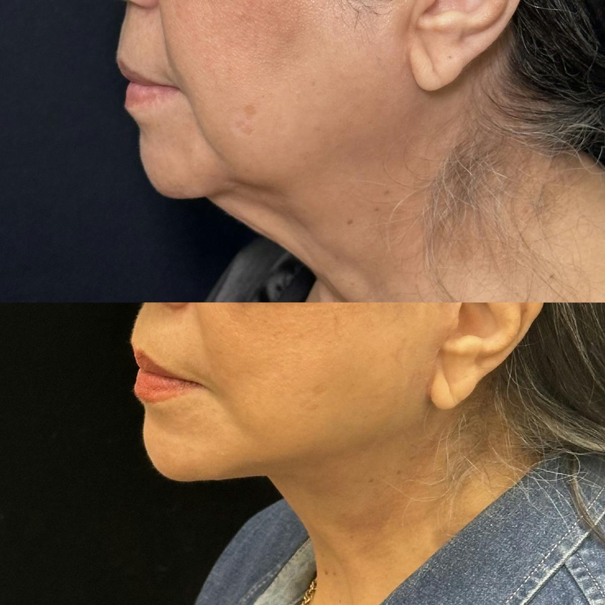 Necklift Before & After Gallery - Patient 242410 - Image 4