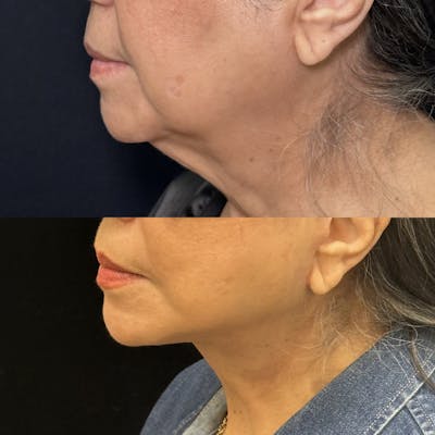 Deep Plane Facelift Before & After Gallery - Patient 209678 - Image 4