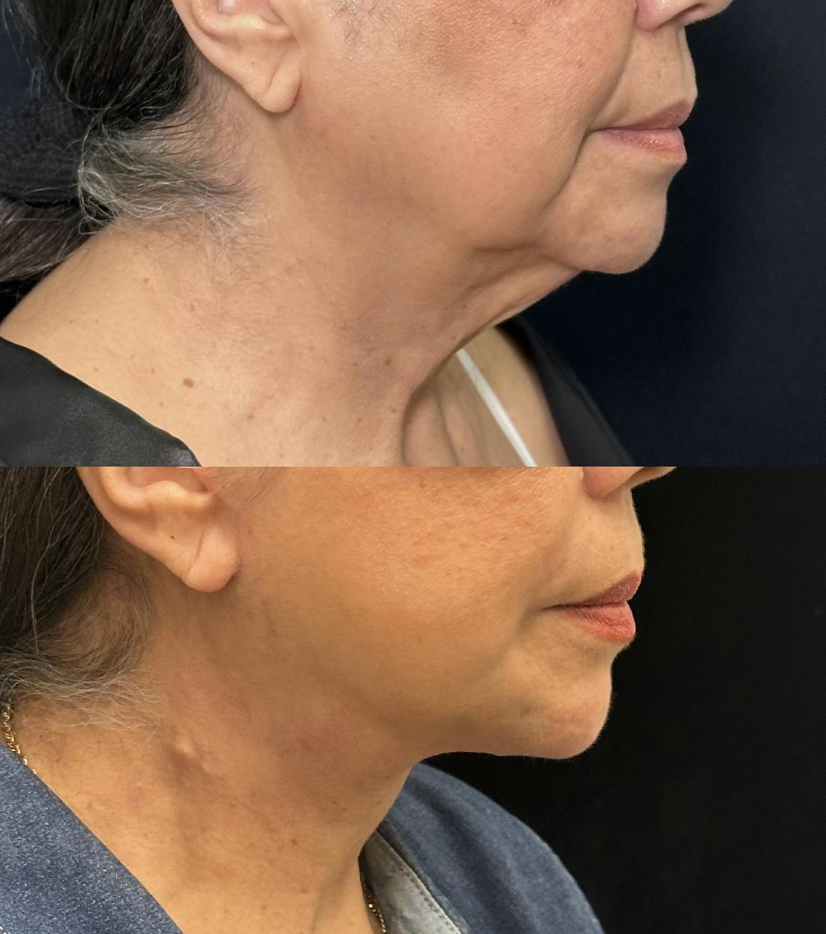 Necklift Before & After Gallery - Patient 242410 - Image 2