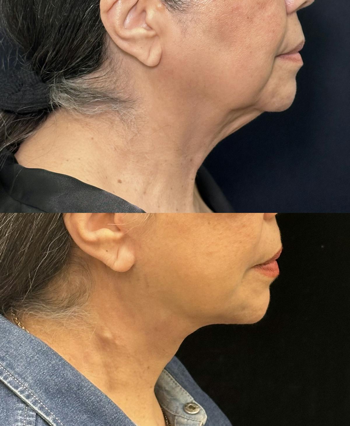 Necklift Before & After Gallery - Patient 242410 - Image 1