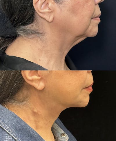 Deep Plane Facelift Before & After Gallery - Patient 209678 - Image 1
